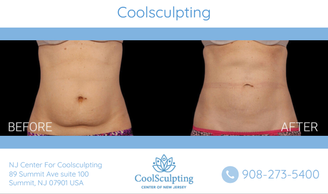 Coolsculpting Before And After Picture