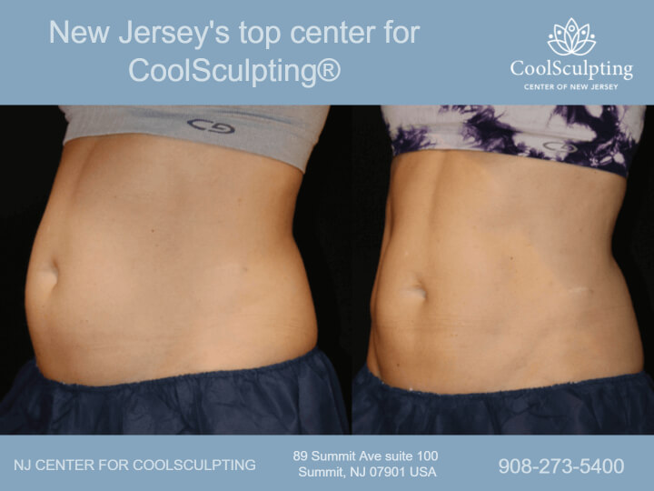 What Causes Belly Fat in Women? - NJ Center for CoolSculpting