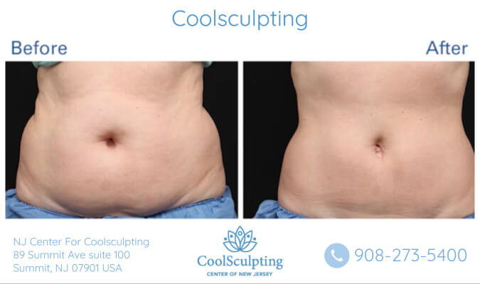 before and after image of coolsculpting