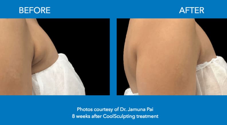 Can CoolSculpting Reduce Underarm Breast Tissue? - NJ Center for