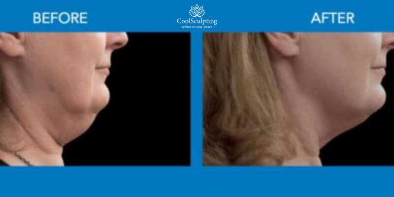 Neck coolsculpting before and after