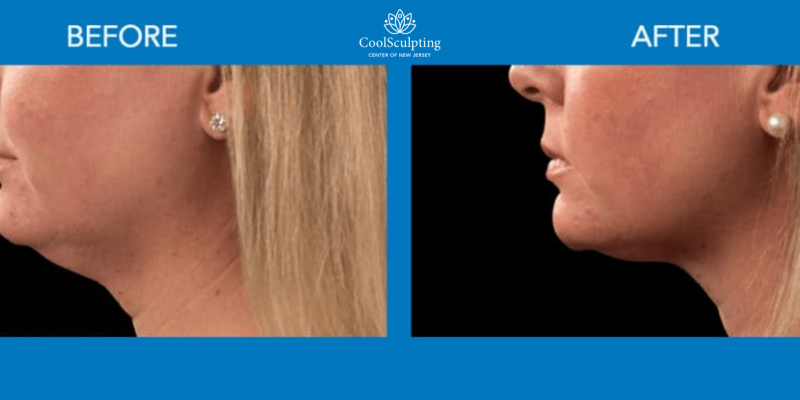 Neck Coolsculpting before and after