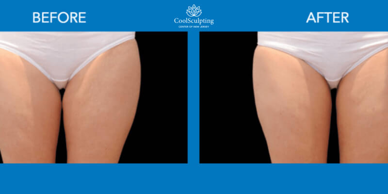 Coolsculpting Thighs before and after