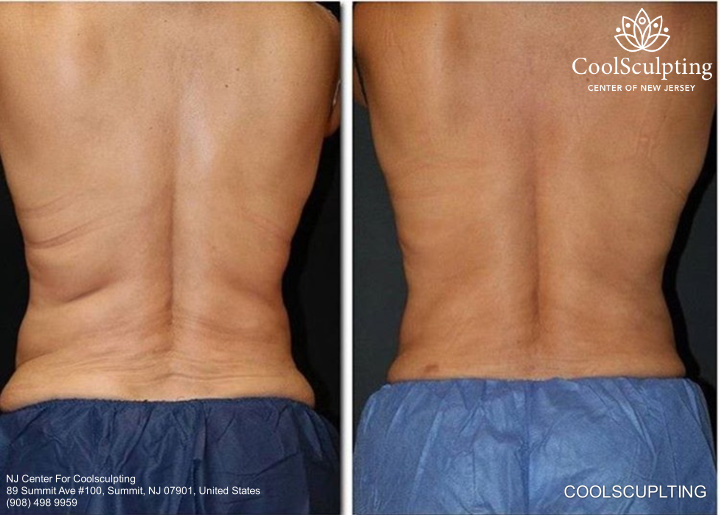 Body back before and after  coolsculpting