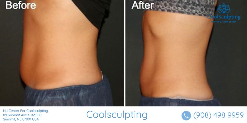 Stomach before and after coolsculpting