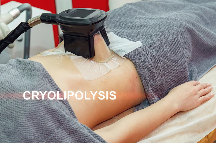 Cryolipolysis treatment application on stomach