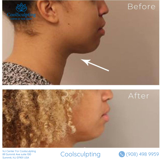 Chin before and after coolsculpting
