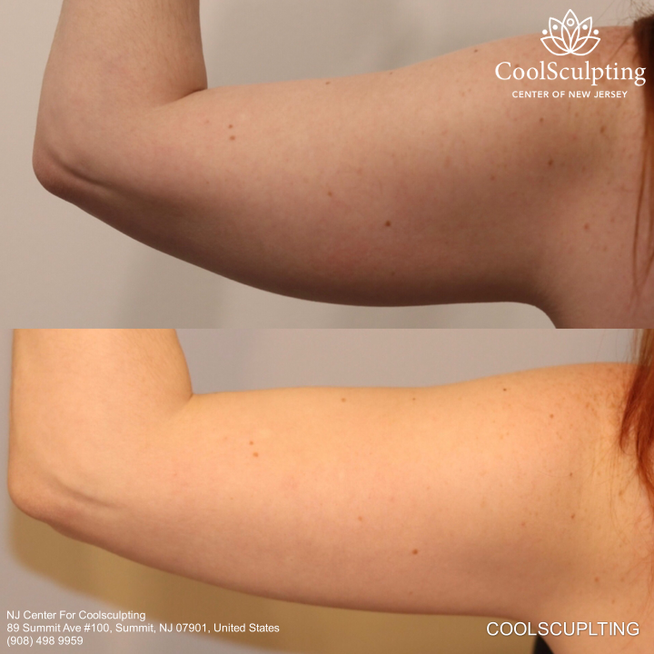 Arm before and after coolsculpting
