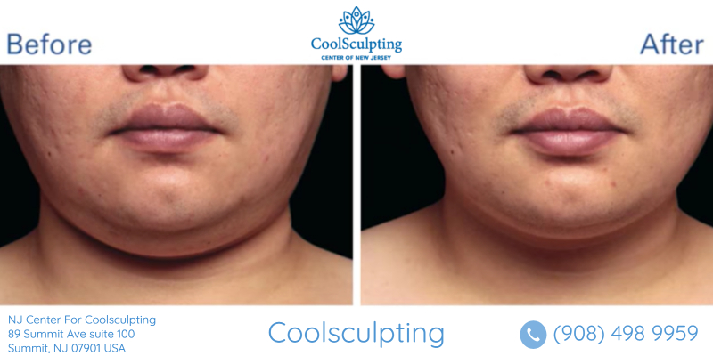 chin before and after coolsculpting