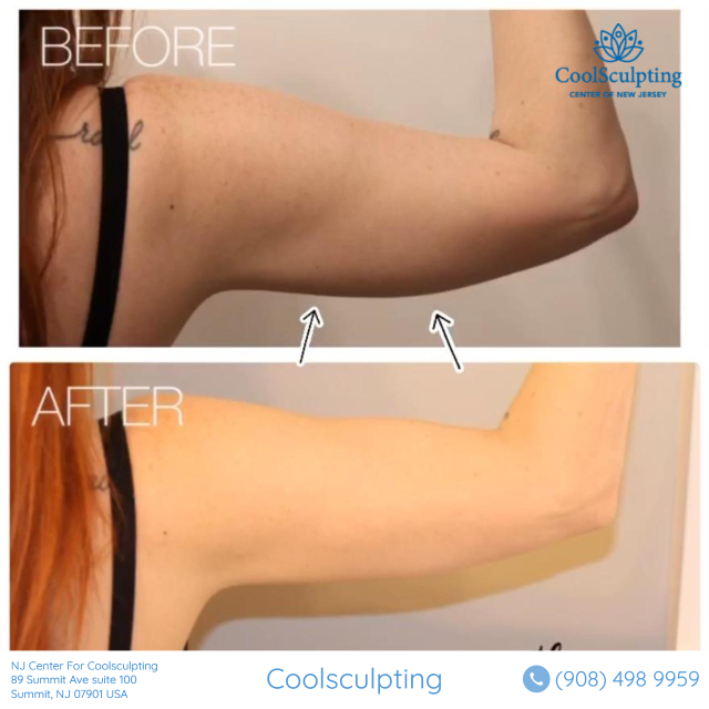 arms before and after coolsculpting