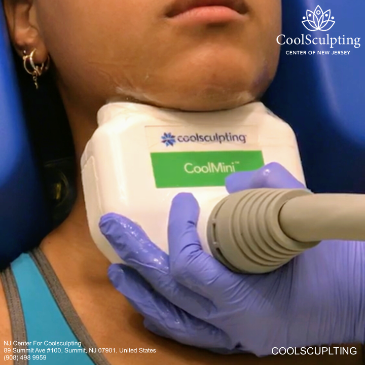 Chin Coolsculpting at NJ Center for Coolsculpting