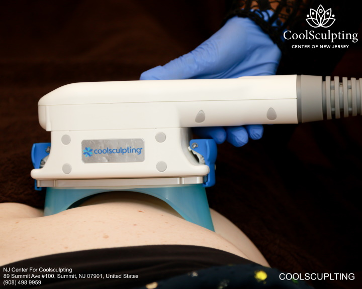 coolsculpting on tummy