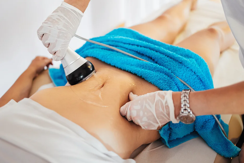 Coolsculpting on Stomach